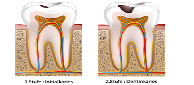 Zahnarzt Selters Karies Stufe 1 und 2
