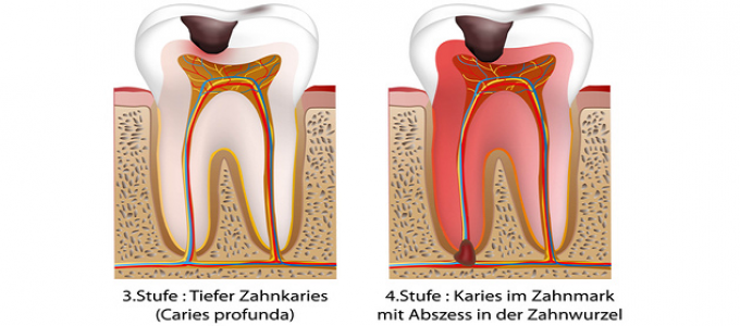 Zahnarzt Selters Karies Stufe 3 und 4