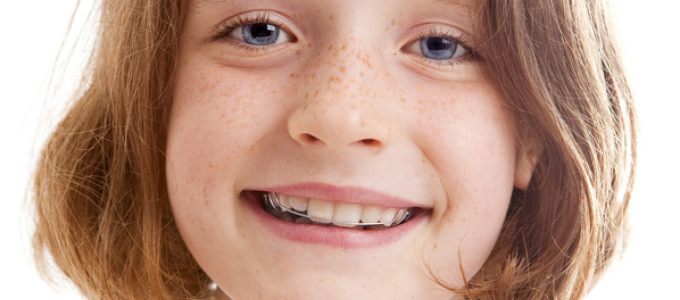 Zahnarzt Selters lose Spange Kinder